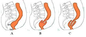 extreme anal exam - Rectal prolapse - Wikipedia