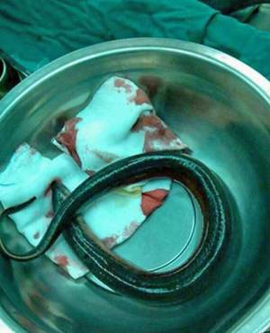 Japanese Eel In Ass Porn - Chinese Hospitalized After Putting Live Eel In His Anus