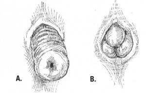 extreme anal exam - Rectal prolapse - Wikipedia