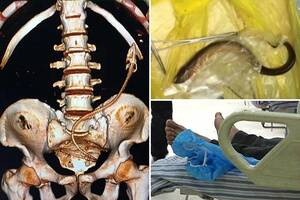 Eel In Ass Porn - Doctors remove a live EEL from the anus of a man who refused to say how it  got there | The Irish Sun