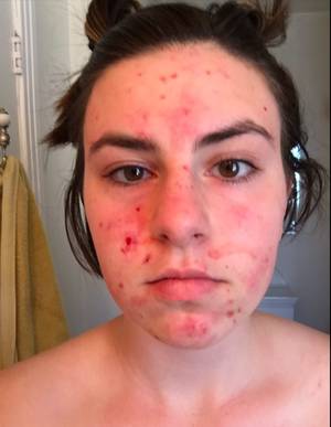 Acne Teen - Girls with acne porn - Video sex pelajar sma jpg 717x925