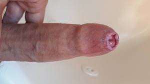 huge red penis - Penis after stretching phimosis