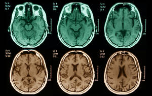 Mri Porn - Groundbreaking Neuroscience Study Finds Striking Similarities in Brains of  Porn and Drug Addicts