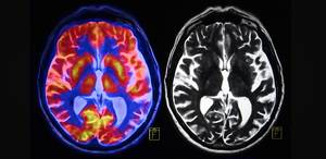 Mri Porn - Porn, Addiction, and the Brain: 3 Misunderstandings Corrected By a  Neurosurgeon